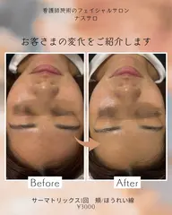 ⭐️リフトアップ効果実感/お試し価格⭐️【サーマトリックス/オリジオ同様効果】✔️1パーツのみ〜施術したい部位追加可能〜