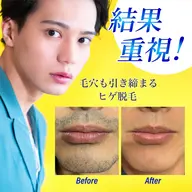 【メンズ髭脱毛】清潔感が無くなるブツブツ青髭とさよなら★美肌ヒゲ脱毛体験