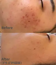 【ニキビケア】プラズマシャワー＋美容液導入¥5,000