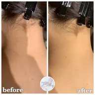 🉐◎4月限定◎【背中ニキビケア/毛穴】 背中全体＋うなじ脱毛 ￥14960⇒¥5980