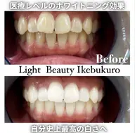 もっと激白ホワイトニング‼️圧倒的な白さ✨✨Wホワイトニング✨✨《合計110分照射3来店コース》✨🦷✨