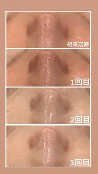 リピーター様用✨剥けない、痛くない、ダウンタイム無し🌿ハーブピーリングで肌育。トラブル知らずなツヤ肌を作ります🩵