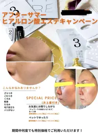 超音波ヒアルロン酸 美顔エステ