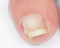 🌟ご新規様限定🌟【巻き爪】B/Sブレイス 両親指(初回他店オフ無料) 甘皮ケア付き✨