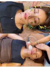 変化整形級⭐️一番人気【美容鍼＋EMS＋高周波＋キャビテーション＋美容液導入】頭蓋骨矯正、骨格矯正付きリフト特化