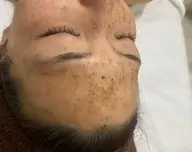 ハーブピーリング(剥離あり・毛穴クリーニング付)