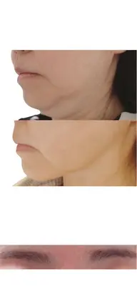 レッドショット1cc