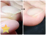 軽度の巻爪カット