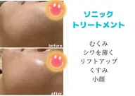 【ソニックトリートメント】🎀きめ細かな美肌へ🎀✨即実感✨小顔、リフトアップ、むくみ、くすみなど様々なお悩みに