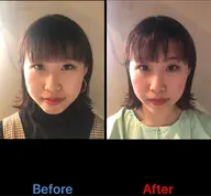 新価格⭐️小顔コース⭐️美容鍼＋パイラソード