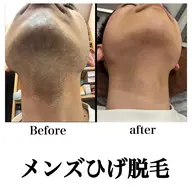 メンズ　髭ひげ脱毛　【痛み少なく美肌効果が高くおすすめ】￥5500