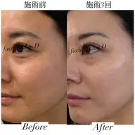 【プレミアム】特許技術で毛穴・シミ・シワお悩み全てにアプローチで肌再生♪（ソフトシェービング付）￥14000→￥6720