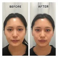 ☆リフトUP特化コース☆小顔ラジオ波+EMS+高保湿パウダー