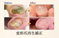 【足の分厚い爪、深爪再生補正】思わず隠したくなるその爪、、😰諦めないで下さい✨正常な爪へ再生致します🔅