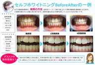 歯のセルフホワイトニング　ホワイトニング最新機種導入