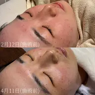 【人気No.1】フェイス＋うなじワックス脱毛｜マッサージ＋鎮静付✨透明感＆垢抜け肌へ