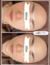 小顔リフトアップ✨シンプルコース