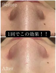 導入記念価格！鼻の黒ずみ改善！！全顔ハイドラ毛穴洗浄！※当店のハイドラ毛穴洗浄が初めての方限定