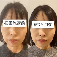 眼精疲労・食いしばりケア|テラボーラー表情筋ほぐしケア 残り4名様