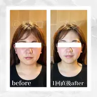 【欲張りMENU】美肌と小顔のW効果★毛穴洗浄ハイドラ×RF×ポレーション導入