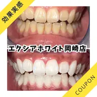 【人気No.1】高濃度プレミア歯科ホワイト90分通常¥14,300円→¥12,100円✨️【コーティング付き40分照射】