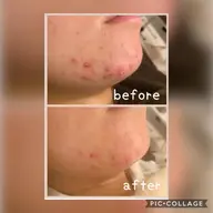 minimo限定　ニキビケアコース『ダチョウ抗体でアクネ菌おやすみなさい💤』お顔、首、デコルテのリンパマッサージ付き✨