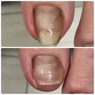フット巻き爪矯正【¥8,000→¥5,000】ケア付き