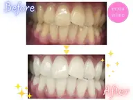 【minimo掲載記念】セルフホワイトニング(9分3セット)1回¥1980 別途料金なし