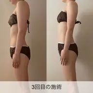 ✨ブライダル前に大人気✨背中・二の腕集中ケアプログラム〈50分〉セルライトゼロ × EMS × オイルリンパ〈50分〉