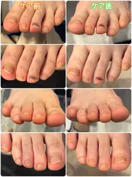フットトラブルケアご相談プラン