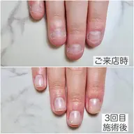 毎月3名様限定🐻✨《22歳以下の特別価格》深爪育成３回コース！埼玉大宮深爪矯正、深爪育成