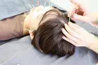 【ビフォーアフターのお写真撮影OKな方限定】美容鍼¥7500→5500 メンズの方にも人気!!