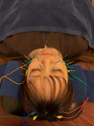 【当日限定】💆🏻‍♀️美容鍼+ヘッドマッサージ 70分 (施術50分+カウンセリングホームケア指導20分)