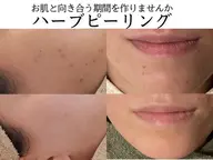 【剥離あり】ハーブピーリング