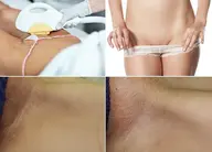 【美容VIO脱毛＋色素ケア】エステ唯一の抜けと美肌&美容トーニングで色素ケア♪2回目以降はVIO脱毛を全回数無料