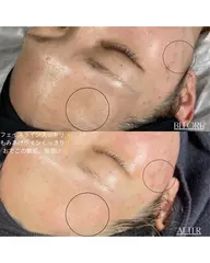 ミニモ限定価格/モニター募集/フェイスワックス🪉&ハーブピーリング🌿