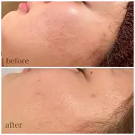 剥けない痛くないのに効果抜群❣️ハーブピーリング✳︎【軽度​〜​中度】1.5g🌿