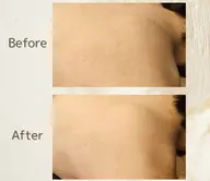 背中シェービング