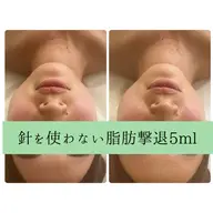 🌸新生活応援🌸残5名様💠針を使わない脂肪撃退&ハイパーナイフEX🙆‍♀️お顔5ml