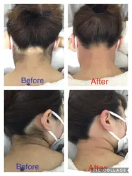 【お得なセットメニュー🉐】顔とうなじのシュガーリング脱毛