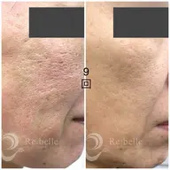 特別初回モニターハーブピーリング