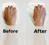 【minimo限定】選べるミニパーツ⭐︎シュガーリング脱毛【胸周りorへそ周りor手の甲＆指】