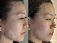 プラズマ光フェイシャル