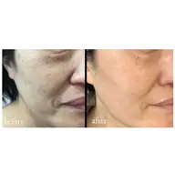 お肌を土台から元気に【光フェイシャル＋顔脱毛】１回　￥5500