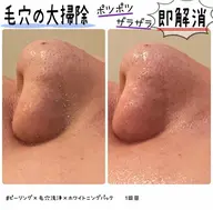 ニキビケア/化粧崩れ卒業🙆‍♀️✨ソフトピーリング毛穴洗浄+ホワイトクリアパック¥5,500