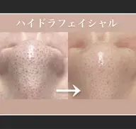 【口コミ投稿限定】毛穴洗浄コース　黒ずみ/いちご鼻に👃濃密ホワイトハニーで美肌へ♪