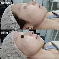 即効！小顔💖ゾンビマスク＆ハイドロジェリーマスク《シワ/リフトアップ/毛穴/ハリ･ツヤ/高保湿》