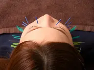 【美容鍼単品】▷美顔鍼50本▷パルス美顔鍼▷高濃度炭酸ミスト