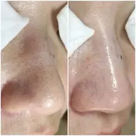 【毛穴洗浄コース】毛穴の悩み改善