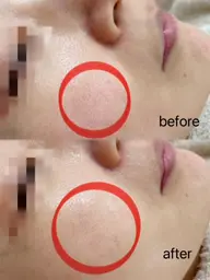 【毛穴×ニキビケア】5step!肌のキメと美白♪全顔毛穴洗浄吸引+全顔酵素ピール+毛穴引き締めエッセンス¥5500